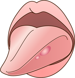 舌に発生した口内炎と 舌癌の見分け方を教えてください シカシル
